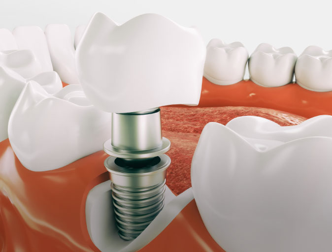 Aiken Dental Implants